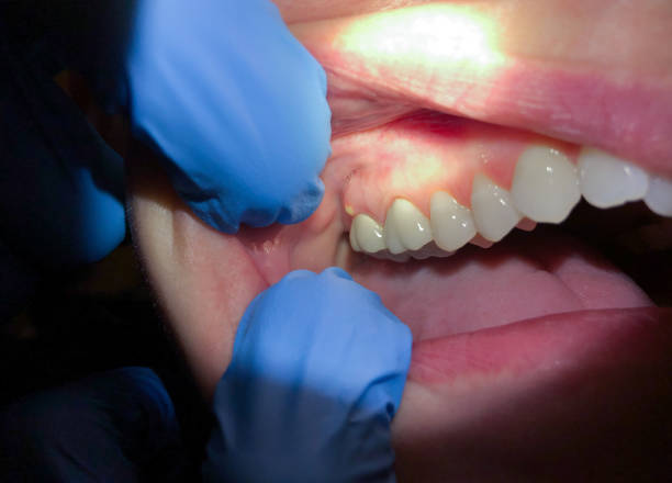 Best Dental Abscess Treatment in Riverview, DE
