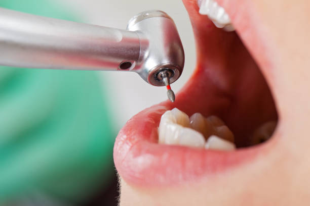 Best Knocked-Out Tooth (Avulsed Tooth) Treatment in Riverview, DE